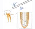 Needle tips for root canal irrigation I-tips